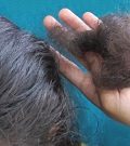 болезни волос - алопеция