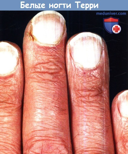 Белые ногти Терри