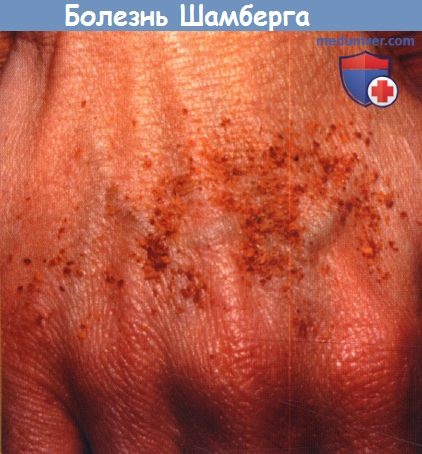 Прогрессирующий пигментный дерматоз (болезнь Шамберга)