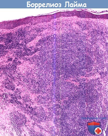 Гистология болезни Лайма - кожная боррелиозная лимфоцитома