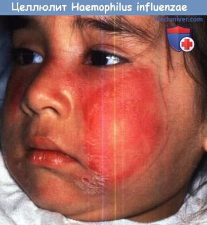 Целлюлит кожи лица Haemophilus influenzae