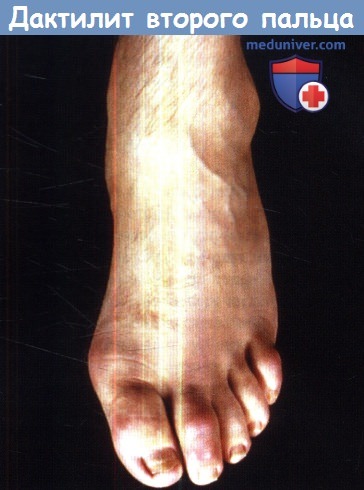 Реактивный артрит второго пальца стопы