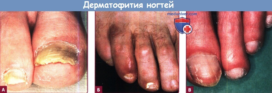 Дерматофития ногтей