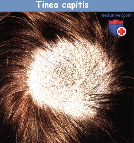 Дерматофития волосистой части кожи головы (Tinea capitis)