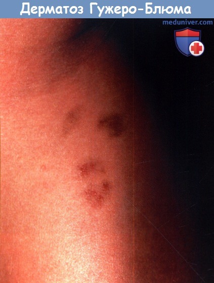 Пурпурозный лихеноидный пигментный дерматит (синдром Гужеро-Блюма)