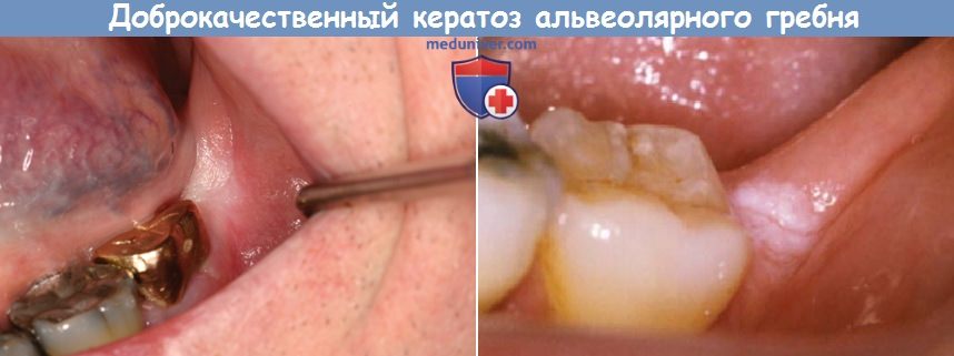 Доброкачественный кератоз альвеолярного гребня (ДКАГ, простой хронический лишай полости рта)