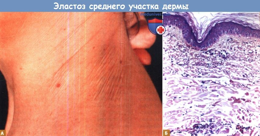 Эластоз среднего участка дермы