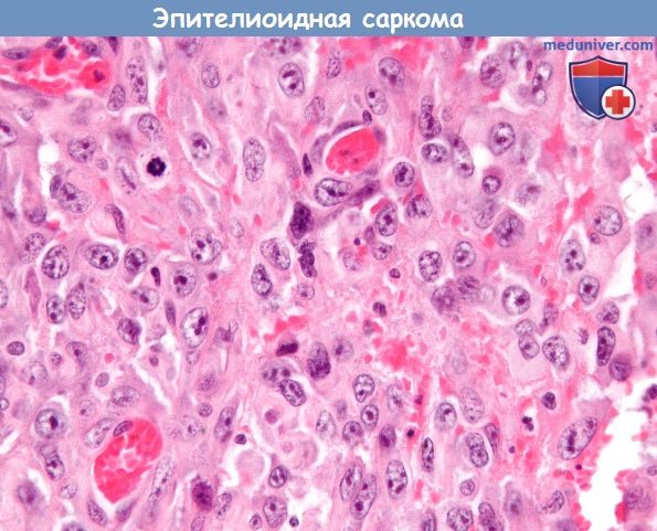 Гистология эпителиоидной саркомы
