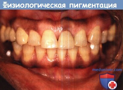 Физиологическая расовая пигментация слизистой рта