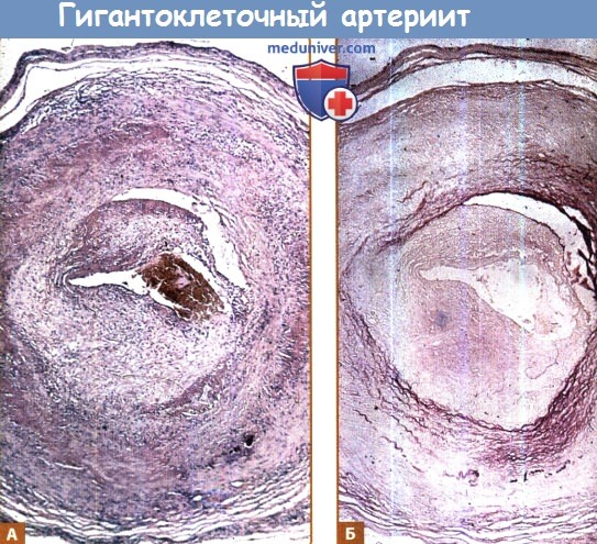 Гистология гигантоклеточного артериита