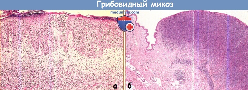 Гистология грибовидного микоза