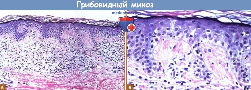 Гистология грибовидного микоза