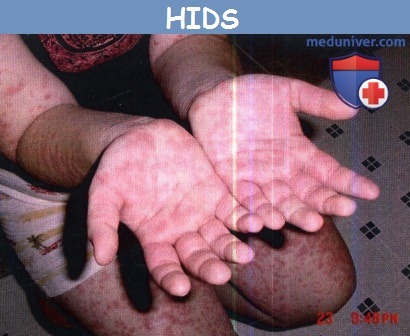Гипериммуноглобулинемия D с синдромом периодической лихорадки (HIDS)