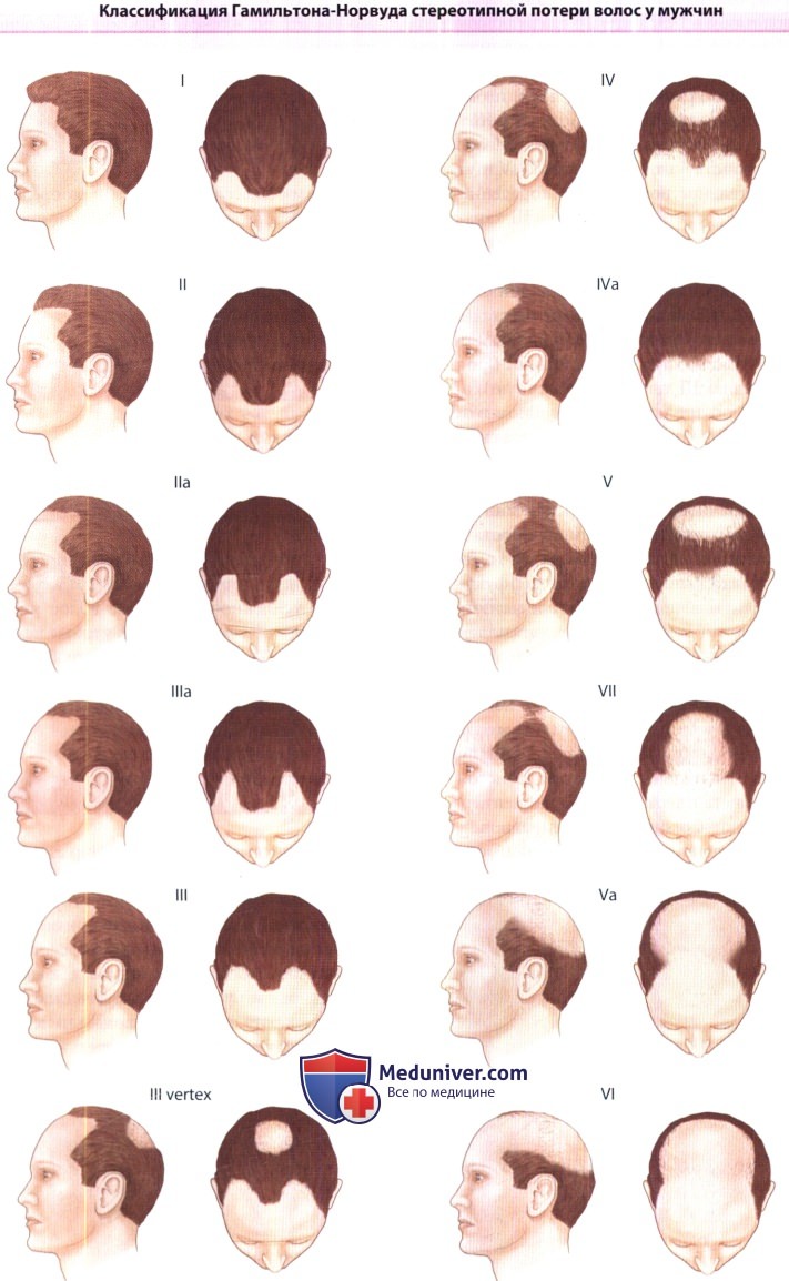Классификация потери волос у мужчин