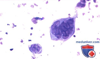 Клетки Тцанка при вирусе простого герпеса