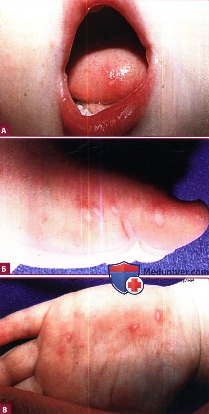 Кожа при болезни рук, ног и рта (энтеровирусной инфекции Коксаки)