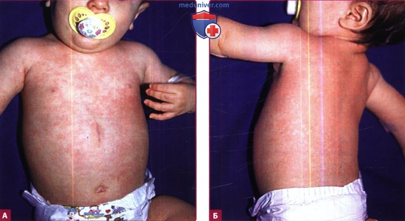 Кожа при внезапной экзантеме (детской розеоле, шестой болезни, инфекции ВГЧ-6)