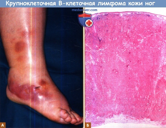 Первичная крупноклеточная В-клеточная лимфомы кожи ног (ПКДКВКЛ)