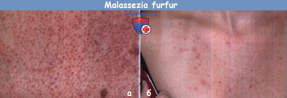 Malassezia furfur