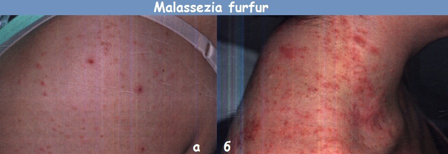 Malassezia furfur