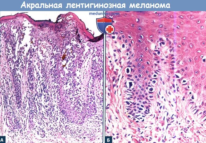 Акральная лентигинозная меланома