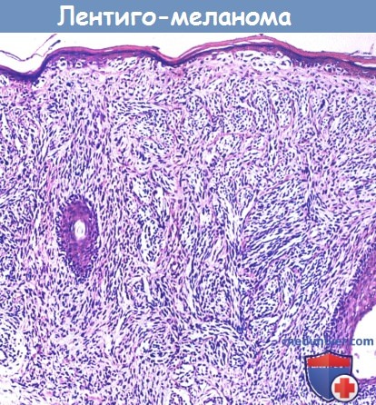 Гистология лентиго-меланомы