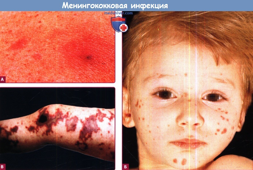 Менингококковая инфекция у ребенка