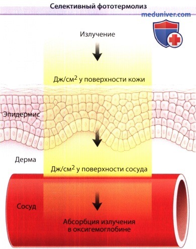 Лазерное воздействие на кожу skinlift ru