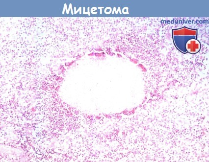 Гистология мицетомы