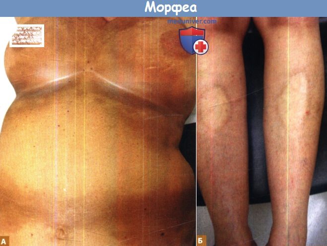 Морфеа - локализованная склеродермия