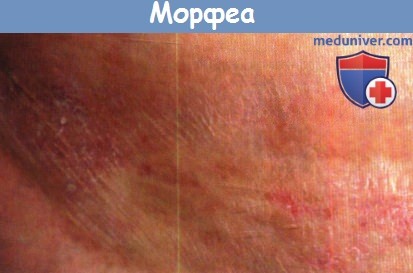 Морфеа - локализованная склеродермия