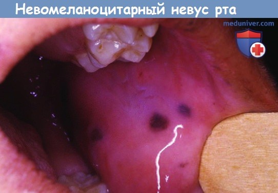 Невомеланоцитарный невус рта