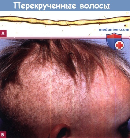 Перекрученные волосы и синдром Менкеса