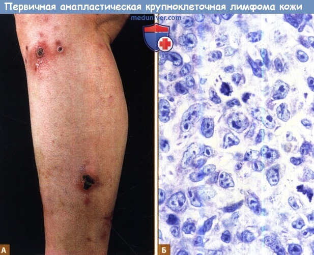 Первичная анапластическая крупноклеточная лимфома кожи (ПАКЛК)