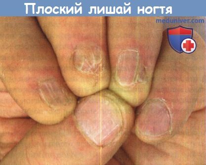 Лечение красного лишая ногтей thumbnail