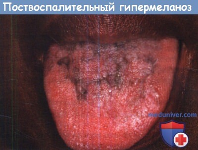 Поствоспалительный гипермеланоз слизистой рта