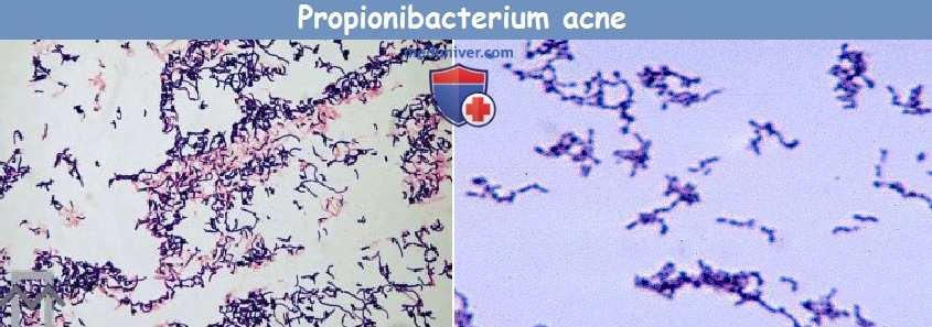 Propionibacterium acne