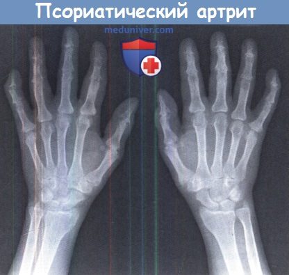 Псориатический артрит (ПсА) на рентгенограмме