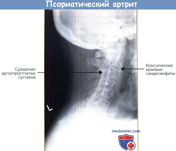 Псориатический артрит (ПсА) на рентгенограмме