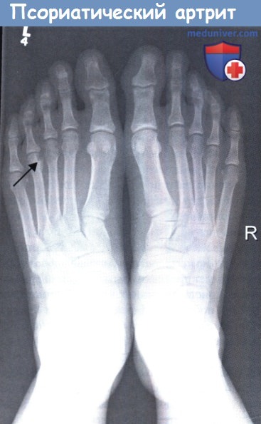 Рентгенограмма стоп при псориатическом артрите
