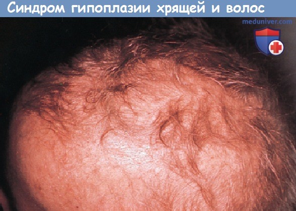 Синдром гипоплазии хрящей и волос