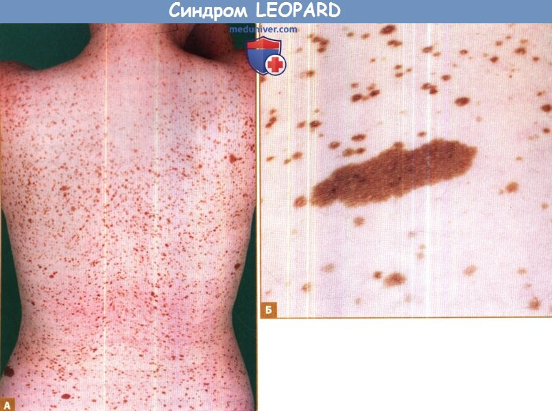 Синдром LEOPARD