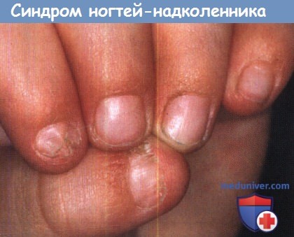 Синдром ногтей-надколенника