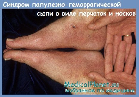 Синдром папулезно-геморрагической сыпи в виде перчаток и носков