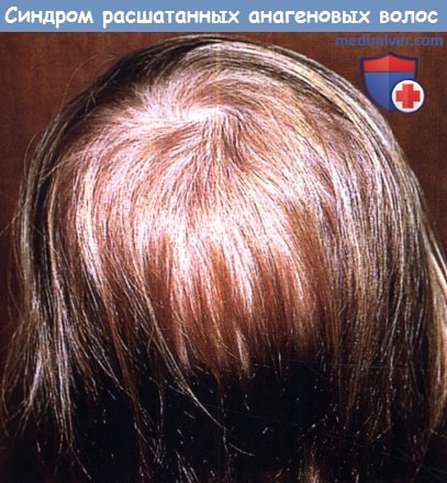 Синдром расшатанных анагеновых волос