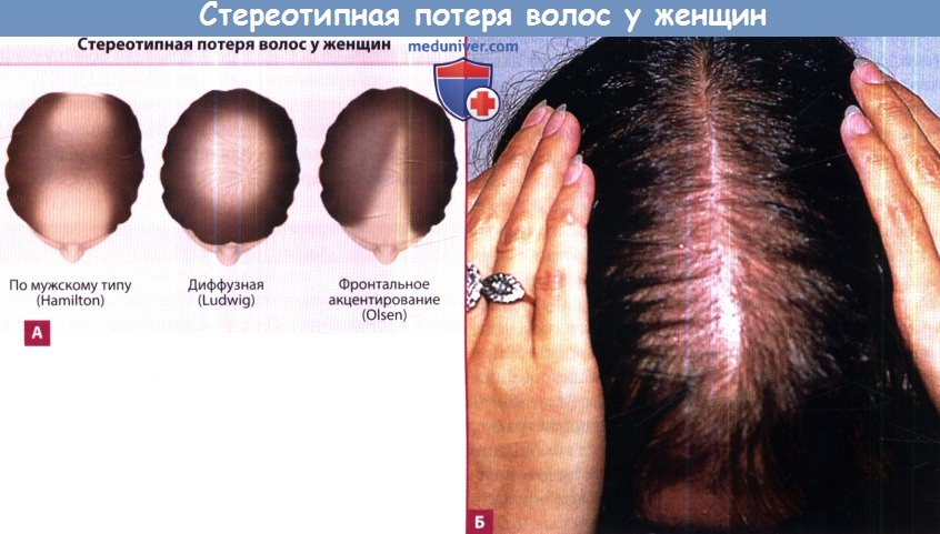 Стереотипная потеря волос у женщин