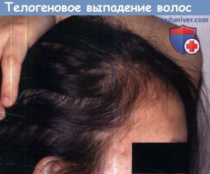 Телогеновое выпадение волос