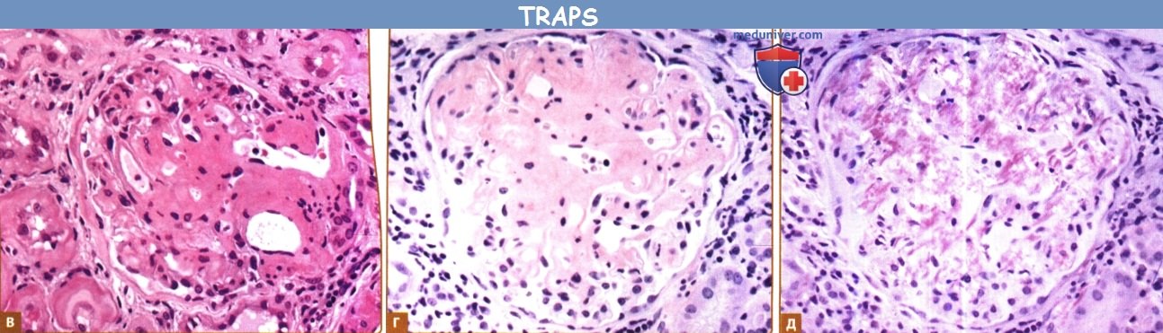 Периодический синдром, связанный с рецептором фактора некроза опухоли (ФНО) - TRAPS