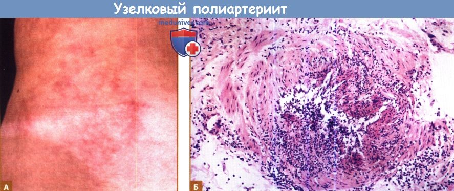 Гистология узелкового полиартериита