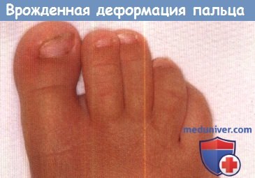 Врожденная деформация большого пальца стопы